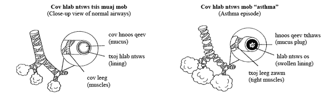 illustration of normal airways and during an asthma attack in Hmong