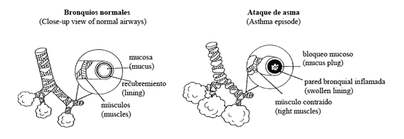 illustration of normal airways and during an asthma attack in Spanish